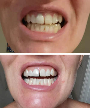 TELYSI Purple Teeth Whitening Strips